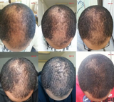 Hair Regrowth Oil + Hair Regrowth Shampoo (Free)